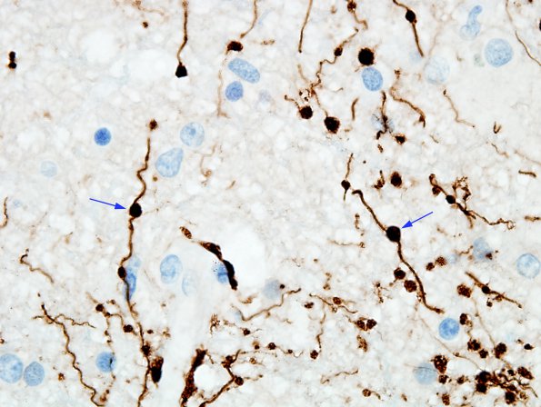 2F16 NMO Spectrum Disorder (Case 2) Anti-GFAP 100X 1 copy