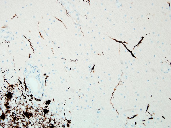 2F9 NMO Spectrum Disorder (Case 2) Area A Anti-GFAP 20X