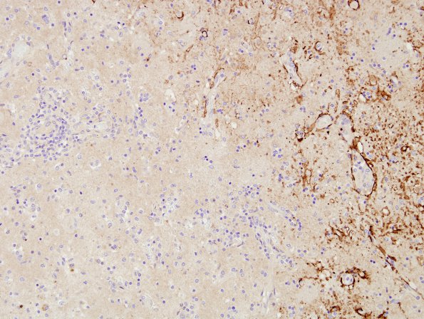 2H6 NMO (Case 2) Basal Ganglia Block A1 Aquaporin-4 9