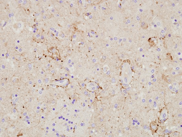 2H7 NMO (Case 2) Basal Ganglia Block A1 Aquaporin-4 11