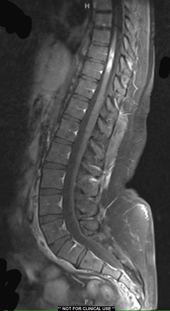 3A1 NMO Spectrum Disorder (Case 3) T1 W (2) - Copy