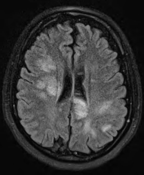 3A2 NMO Spectrum Disorder (Case 3) T2 FLAIR - Copy