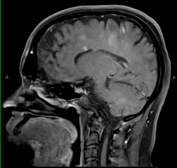 3A3 NMO Spectrum Disorder (Case 3) T1 W 6 - Copy