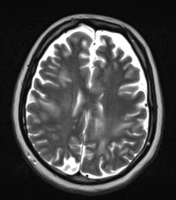 3A4 NMO Spectrum Disorder (Case 3) T2 - Copy