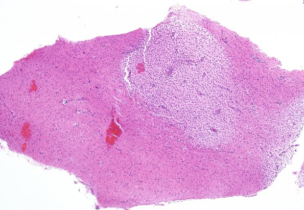 3B1 NMO Spectrum Disorder (Case 3) H&E 5