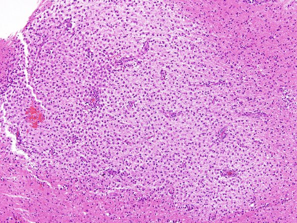 3B2 NMO Spectrum Disorder (Case 3) H&E 4