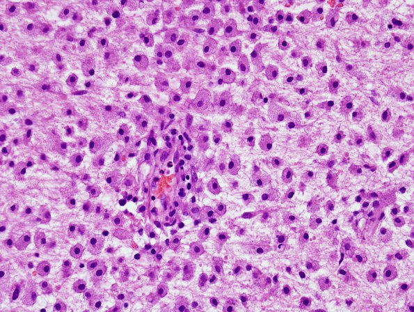 3B3 NMO Spectrum Disorder (Case 3) H&E 6