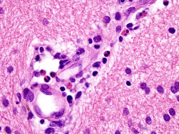 3B4 NMO Spectrum Disorder (Case 3) H&E 10