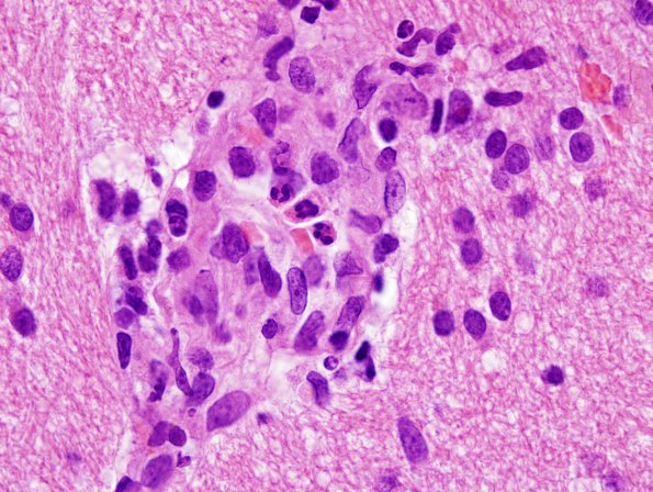 3B5 NMO Spectrum Disorder (Case 3) H&E 1