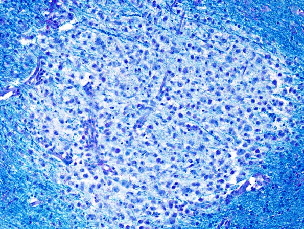 3C1 NMO Spectrum Disorder (Case 3) LFB-PAS 2