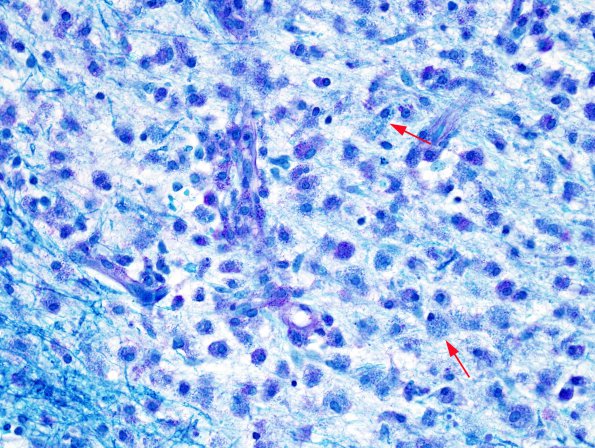 3C2 NMO Spectrum Disorder (Case 3) LFB-PAS 3 copy