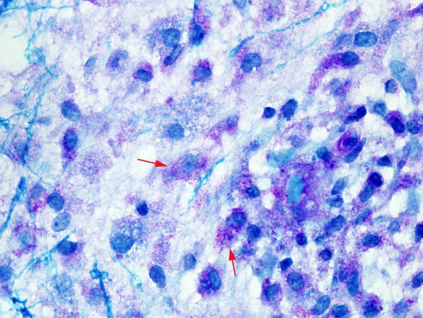 3C3 NMO Spectrum Disorder (Case 3) LFB-PAS 7 copy