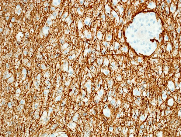 3D2 NMO Spectrum Disorder (Case 3) NF 1