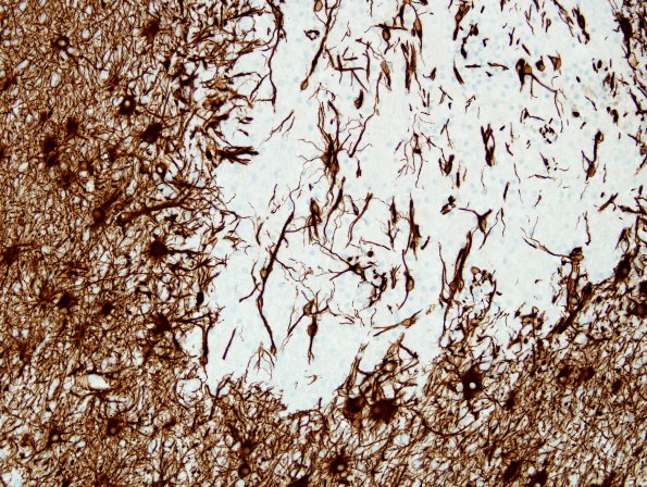 3E2 NMO Spectrum Disorder (Case 3) GFAP 1