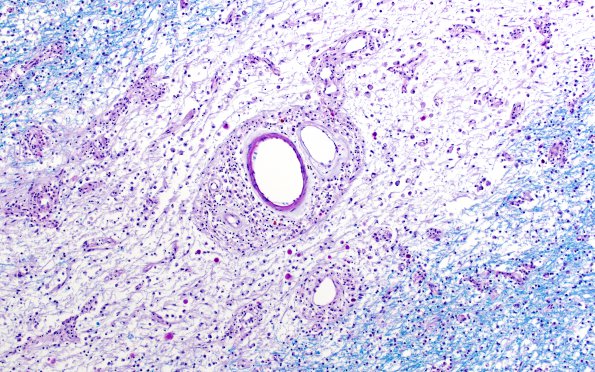 4C4 NMOSD (Case 4) N14 LFB-PAS 10X 2