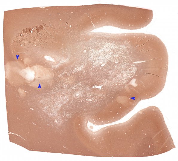 4D1 NMOSD (Case 4) N14 NF whole mount copy