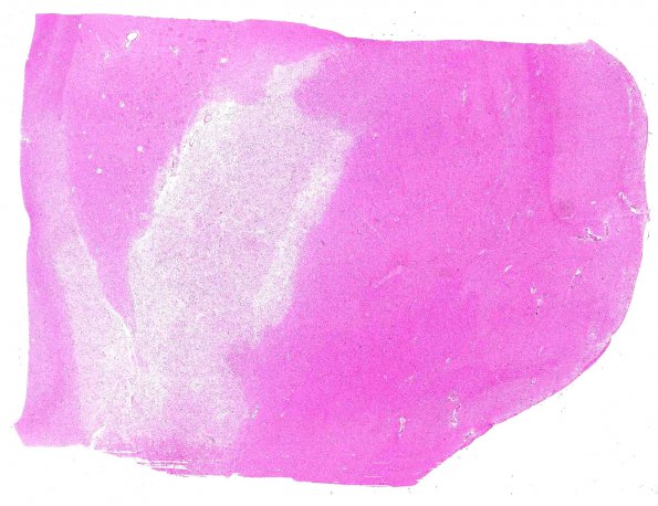 5A1 NMOSD (AANP #7 2009) H&E whole mount 2