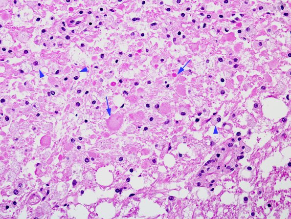 5B3 NMOSD (AANP #7 2009) H&E 2 best copy