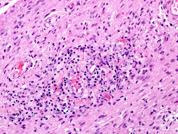 5B4 NMOSD (AANP #7 2009) H&E 4