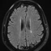 1A1 Neuromyelitis Optica (NMO, Case 1) FLAIR