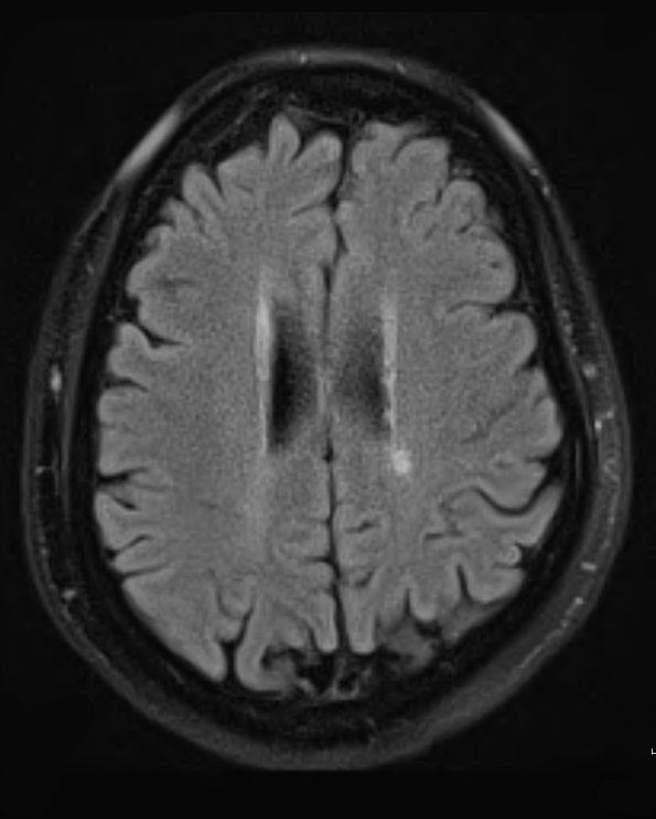 1A1 Neuromyelitis Optica (NMO, Case 1) FLAIR