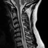 1A2 Neuromyelitis Optica (NMO, Case 1) T2 - Copy