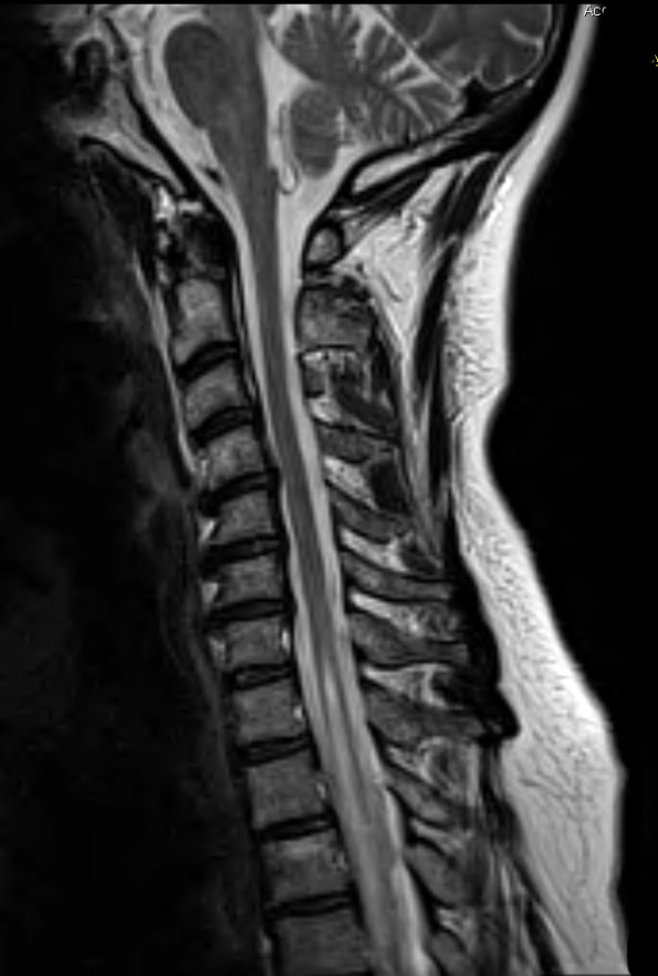 1A2 Neuromyelitis Optica (NMO, Case 1) T2 - Copy