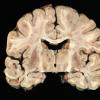 1B1 Neuromyelitis Optica (NMO, Case 1)  Gross_4