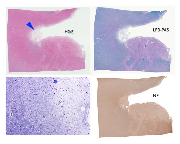 1B2 Neuromyelitis Optica (NMO, Case 1) N16 Possible demyelination copy