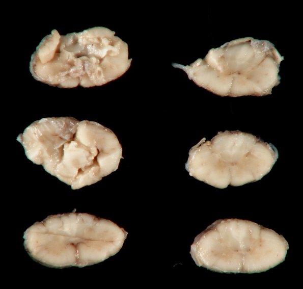 1C1 Neuromyelitis Optica (NMO, Case 1) Gross_18