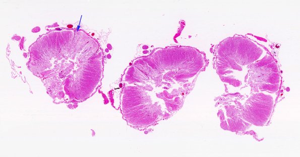 1C2 Neuromyelitis Optica (NMO, Case 1) N12 1 Spinal Cord H&E WM