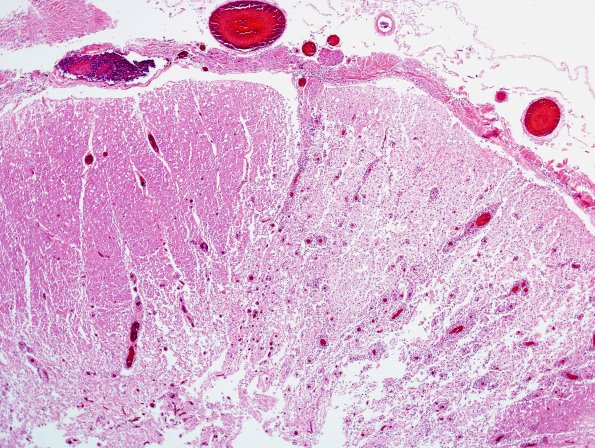 1C3 Neuromyelitis Optica (NMO, Case 1) N12 Spinal Cord H&E 1