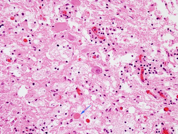 1C5 Neuromyelitis Optica (NMO, Case 1) N12 Spinal Cord H&E 4 copy