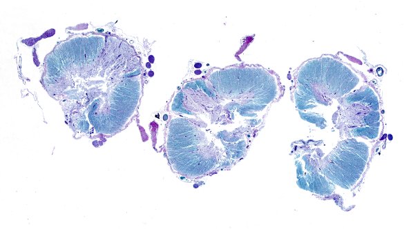 1D1 Neuromyelitis Optica (NMO, Case 1) N12 1 Spinal Cord LFB-PAS whole mount