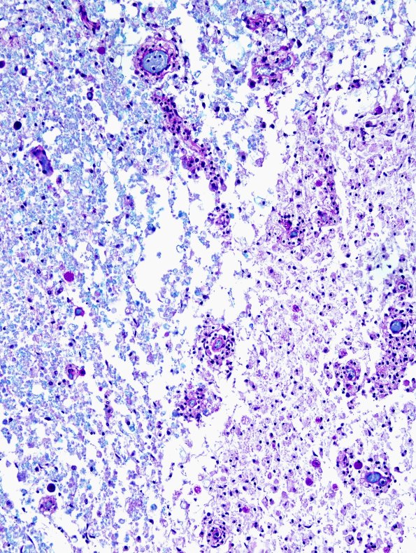 1D2 Neuromyelitis Optica (NMO, Case 1) N12 Spinal Cord LFB-PAS 6