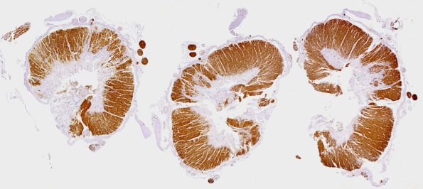 1E1 Neuromyelitis Optica (NMO, Case 1) N12 MBP