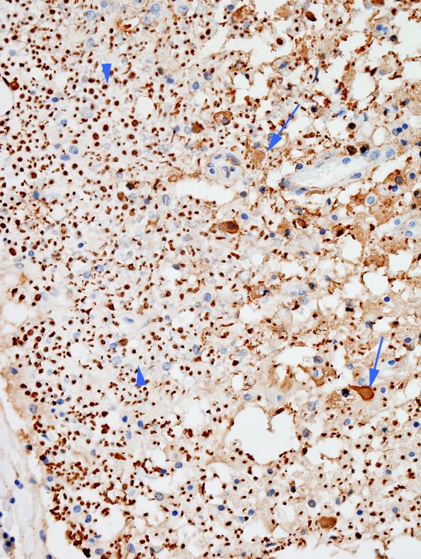 1F2 Neuromyelitis Optica (NMO, Case 1) N12 Spinal Cord NF 1 copy