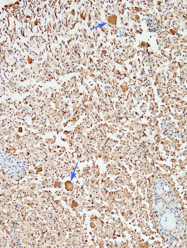 1F3 Neuromyelitis Optica (NMO, Case 1) N12 Spinal Cord NF 6 copy