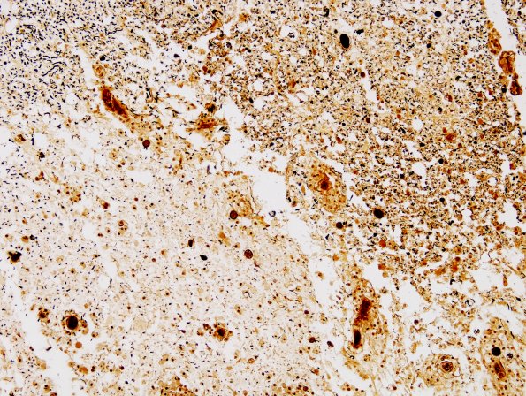 1G3 Neuromyelitis Optica (NMO, Case 1) N12 Spinal Cord Biels 11