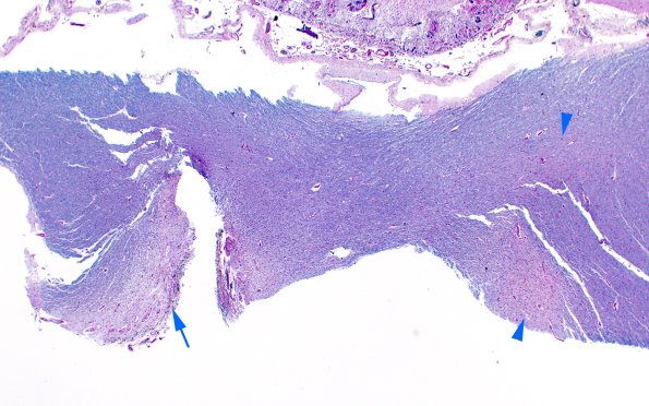 1H1 Neuromyelitis Optica (NMO, Case 1) N21 Optic LFB-PAS 2X copy