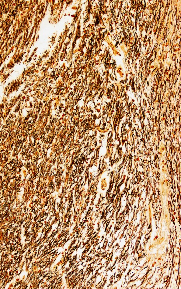 1H4 Neuromyelitis Optica (NMO, Case 1) N21 Optic Biels 20X