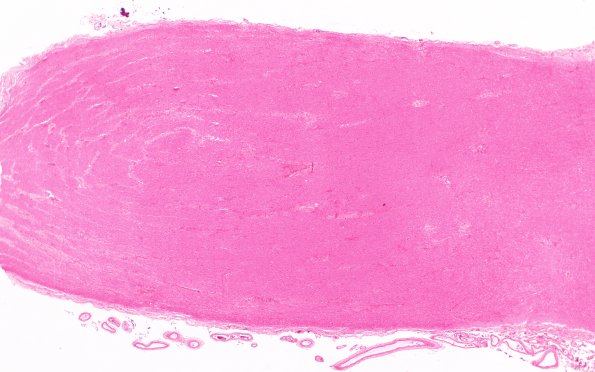 2A2 NMO  (Case 2) N13 Nerve-Chiasm H&E 2X