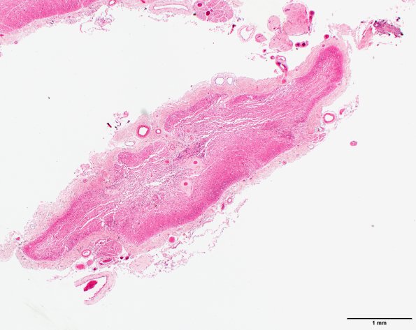 2B2 NMO (Case 2) N11 H&E 2X section 2