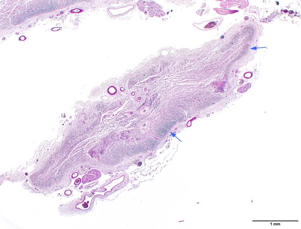 2C1 NMO (Case 2) N11 LFB 2X section 2 copy