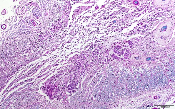 2C2 NMO (Case 2) N11 LFB 10X section 2