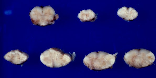 3A1 Neuromyelitis Optica (Case 3)  1