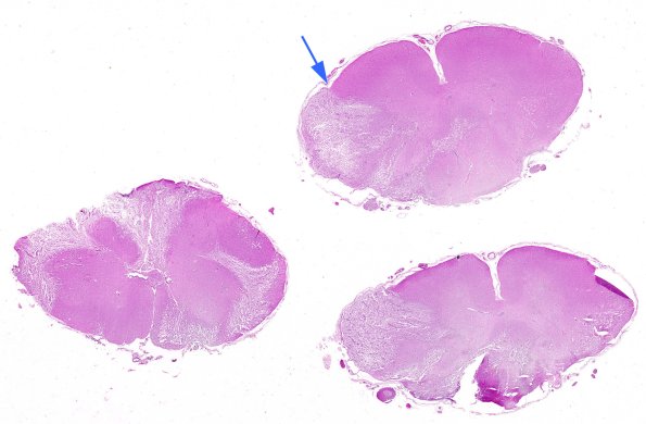 3B1 Neuromyelitis Optica (Case 3) H&E whole mount 2 copy