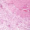 3B10 Neuromyelitis Optica (Case 3) H&E 20X, Block L