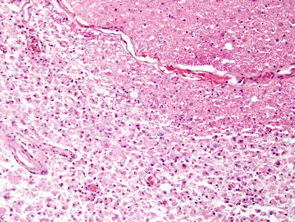 3B10 Neuromyelitis Optica (Case 3) H&E 20X, Block L