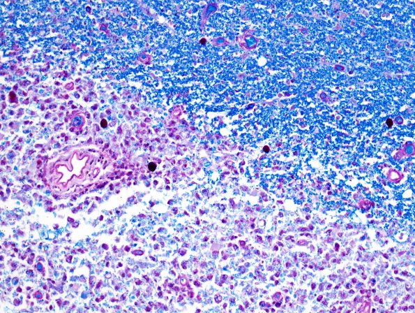 3B10 Neuromyelitis Optica (Case 3) LFB-PAS 20X, Block L